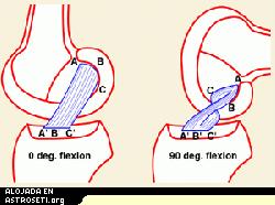 <i>Localizacin del ligamento anterior cruzado entre el fmur y la tibia. El dibujo a la derecha muestra cmo el ACL puede ser girado y desgarrado (de Los ligamentos cruzados de la rodilla, Girgis F.G., Marshal J.L., St.Monajem A.R.S.: Clin Orthop 1975, 106:216-231)</i>
