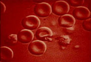 Clulas rojas siendo invadidas por el parsito de la malaria.
Crdito: Centro Cooperativo de Investigacin para la Tecnologa de Vacunas