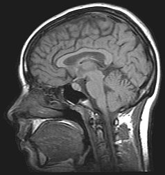 El scanner MRI, una poderosa herramienta para el diagnstico mdico, utiliza electromagnetos superconductores para generar imgenes detalladas de los tejidos corporales. La mayora de las mquinas MRI actuales requieren el costoso helio lquido para enfriar su alambre superconductor de baja temperatura.