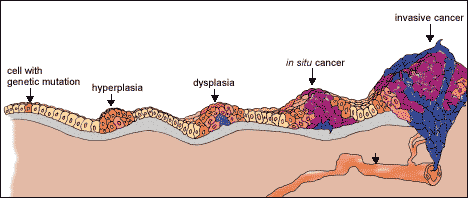 Etapas del desarrollo de un tumor canceroso 
[<a href= http://science.education.nih.gov/supplements/nih1/cancer/guide/understanding1.htm target=_blank><u>Ms informacin</u></a>]
